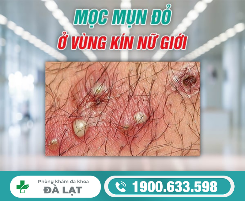 Hình ảnh minh họa